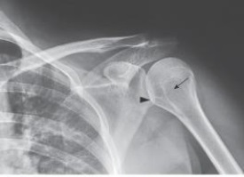 The anatomy labeled in the image below by the arrowhead is the:   A)  acromion. B)  coracoid process. C)  glenoid. D)  lesser tubercle.