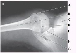 What projection (method)  is demonstrated in the image below?   A)  AP oblique (Grashey)  B)  PA oblique (Scapular Y)  C)  Transthoracic (Lawrence)  D)  Inferosuperior axial (Lawrence) 