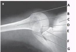 What anatomy is labeled as letter A in the image below?   A)  Greater tubercle B)  Lesser tubercle C)  Acromion D)  Coracoid process