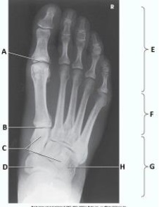 What anatomy is labeled as letter A in the image below?   A)  First metatarsophalangeal joint B)  Proximal interphalangeal joint of first digit C)  Distal interphalangeal joint of first digit D)  Interphalangeal joint of first digit