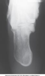 What is the projection and anatomy of interest depicted in the image below?   A)  AP axial calcaneus B)  AP calcaneus C)  Plantodorsal axial calcaneus D)  Superoinferior axial calcaneus