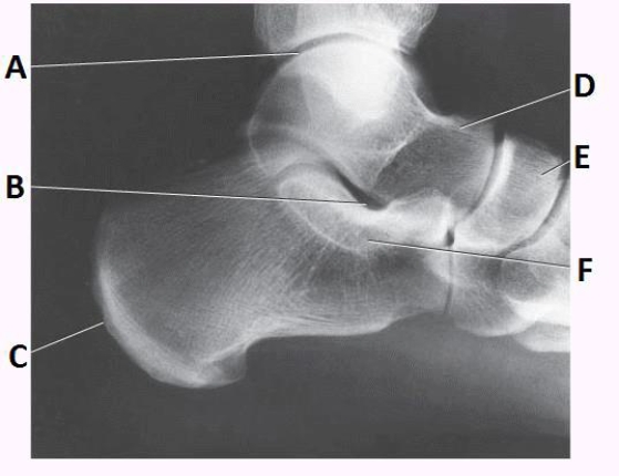 What anatomy is labeled as letter E in the image below?   A)  Sinus tarsi B)  Sustentaculum tali C)  Navicular D)  Tibiotalar joint