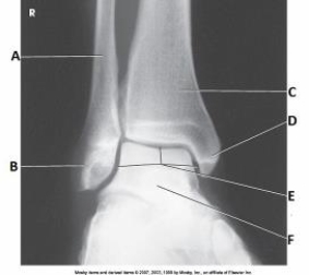 How is the lower limb positioned to obtain the projection in the image below?   A)  30- to 45-degree medial rotation B)  15- to 20-degree medial rotation C)  30- to 45-degree lateral rotation D)  15- to 20-degree lateral rotation