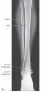 What is needed to complete the projection of the leg in the image below?   A)  Nothing. This is a complete projection. B)  An AP of the knee and proximal leg C)  An AP of the ankle and distal leg D)  A lateral projection of the knee