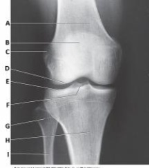 The anatomy labeled with letter E in the image below is the:   A)  medial femoral condyle. B)  lateral tibial condyle. C)  medial tibial condyle. D)  lateral tibial plateau.