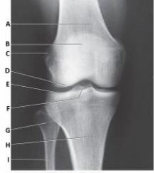 The anatomy labeled with letter F in the image below is the:   A)  tibial tuberosity. B)  intercondylar eminence. C)  medial malleolus. D)  lateral malleolus.