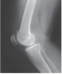 What is the central-ray direction needed to produce the image below?   A)  Perpendicular B)  3 to 5 degrees cephalad C)  5 to 7 degrees cephalad D)  Central-ray angle depends upon patient size