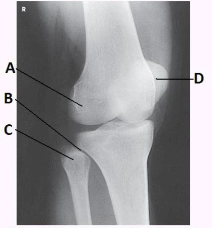 What lower limb position is required to obtain the image below?   A)  Anatomic position B)  45-degree medial rotation C)  45-degree lateral rotation D)  Tibial epicondyles perpendicular to IR