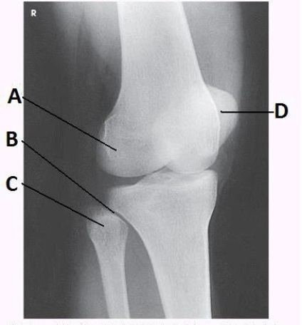 What anatomy is labeled with the letter B in the image below?   A)  Lateral femoral condyle B)  Lateral tibial condyle C)  Proximal tibiofibular joint D)  Tibial tuberosity
