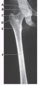 What anatomy is labeled with the letter C in the image below?   A)  Greater trochanter B)  Lesser trochanter C)  Femoral head D)  Femoral neck
