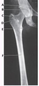 What is the projection and anatomy of interest in the image below?   A)  AP proximal femur B)  AP distal femur C)  Lateral proximal femur D)  Lateral distal femur