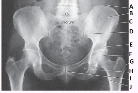 What anatomy is labeled as letter C in the image below?   A)  Iliac crest B)  Ala of ilium C)  ASIS D)  AIIS