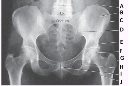 What anatomy is labeled as letter H in the image below?   A)  Pubic symphysis B)  Obturator foramen C)  Ischial tuberosity D)  Superior pubic ramus