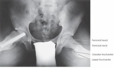 What projection and anatomy of interest is depicted in the image below?   A)  AP oblique (modified Cleaves) ; femoral necks B)  AP oblique (Cleaves) ; femoral necks C)  AP axial (Taylor) ; anterior pelvic bones D)  AP axial (Bridgeman) ; pelvic inlet