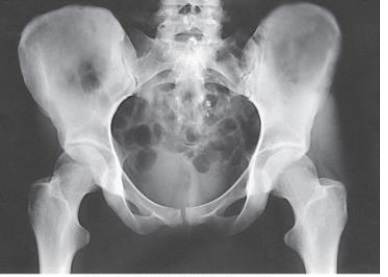 What positioning error is evident in the image below?   A)  None. This image meets all evaluation criteria for this projection. B)  The lower limbs were not internally rotated. C)  The lower limbs were not externally rotated. D)  The knees were not flexed to reduce lordotic curve.