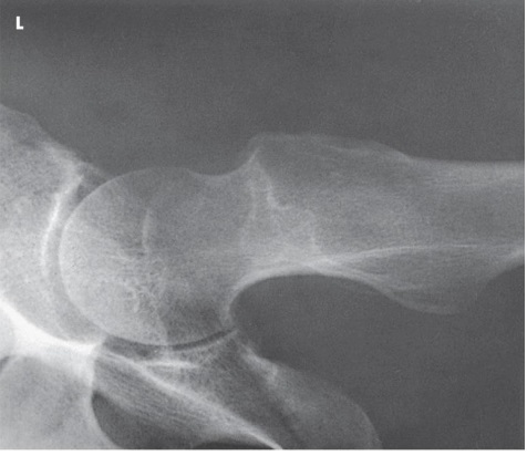 What projection (method)  is demonstrated in the image below?   A)  AP oblique (modified Cleaves)  B)  Mediolateral (Lauenstein)  C)  Axiolateral (Danelius-Miller)  D)  AP oblique (Judet) 