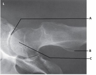 What anatomy is labeled as letter B in the image below?   A)  Acetabulum B)  Femoral head C)  Lesser trochanter D)  Iliac crest