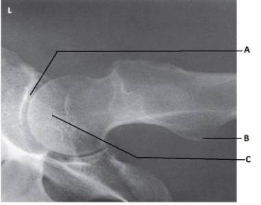 What anatomy is labeled as letter C in the image below?   A)  Acetabulum B)  Femoral head C)  Femoral neck D)  Iliac crest