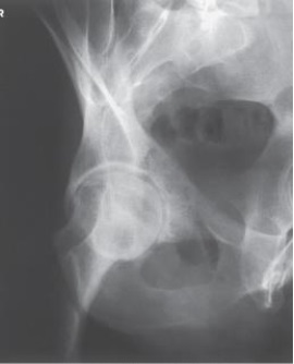 Examine this AP oblique (Judet)  image of the right hip obtained with the patient positioned for the internal oblique. What patient position is depicted?   A)  45 degrees RPO B)  45 degrees LPO C)  45 degrees RAO D)  45 degrees LAO