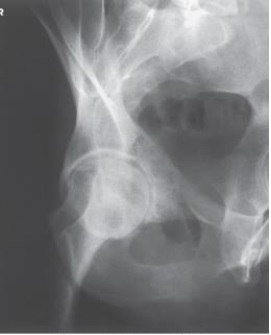 Examine this AP oblique (Judet)  image of the right hip obtained with the patient positioned for the internal oblique. What is the anatomy of interest?   A)  Anterior acetabular rim and iliopubic column B)  Posterior acetabular rim and iliopubic column C)  Anterior acetabular rim and ilioischial column D)  Posterior acetabular rim and ilioischial column