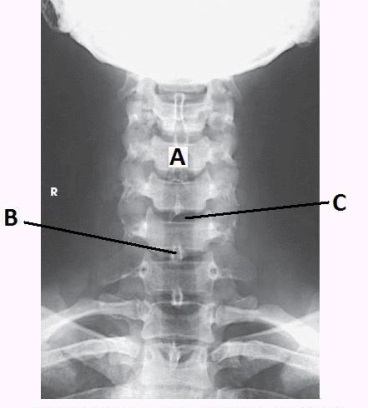 What is the projection and anatomy of interest in the figure below?   A)  AP oblique cervical spine B)  PA axial cervical spine C)  Lateral cervical spine D)  AP axial cervical spine