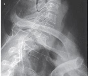 Which projection of the vertebral column is depicted in the figure below?   A)  Lateral cervical spine B)  Lateral cervicothoracic spine C)  AP axial oblique cervical spine D)  Oblique thoracic spine