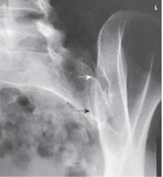 Examine this AP oblique projection image. What patient position was required to obtain this image?   A)  25 to 30 degree LPO B)  25 to 30 degree RPO C)  30 to 45 degree LPO D)  30 to 45 degree RPO