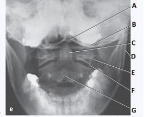 What anatomy is labeled with the letter C in the image below?   A)  Occipital base B)  Lateral mass of C1 C)  Dens of C2 D)  Body of C2