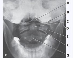 What anatomy is labeled with the letter E in the image below?   A)  Occipital base B)  Lateral mass of C1 C)  Dens of C2 D)  Body of C2