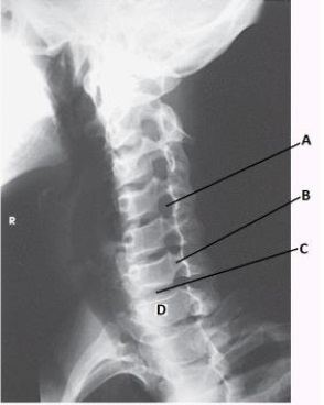 What anatomy is labeled with the letter D in the image below?   A)  T1 B)  C5 C)  C7 D)  T2