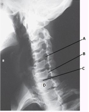 What anatomy is labeled with the letter A in the image below?   A)  Zygapophyseal joint of C4-C5 B)  Zygapophyseal joint of C5-C6 C)  Intervertebral foramen of C4-C5 D)  Intervertebral foramen of C5-C6