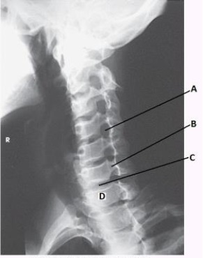What anatomy is labeled with the letter B in the image below?   A)  Lamina of C6 B)  Pedicle of C6 C)  Lamina of C5 D)  Pedicle of C5