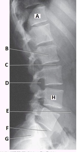 What anatomy is labeled with the letter B in the image below?   A)  Body of L2 B)  Body of L3 C)  Pedicle of L2 D)  Pedicle of L3
