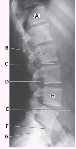 What anatomy is labeled with the letter D in the image below?   A)  Intervertebral foramen of L4-L5 B)  Zygapophyseal joint of L4-L5 C)  Intervertebral foramen of L3-L4 D)  Zygapophyseal joint of L3-L4