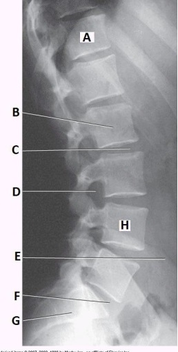 What anatomy is labeled with the letter C in the image below?   A)  Intervertebral foramen of L2-L3 B)  Intervertebral disk space of L2-L3 C)  Intervertebral foramen of L3-L4 D)  Intervertebral disk space of L3-L4