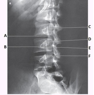 What anatomy is labeled with the letter C in the image below?   A)  L2-L3 zygapophyseal joint B)  L2-L3 intervertebral foramen C)  L1-L2 zygapophyseal joint D)  L1-L2 intervertebral foramen