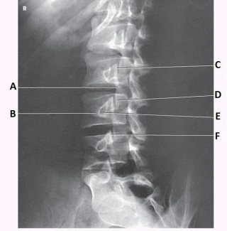 What anatomy is labeled with the letter E in the image below?   A)  L2 pedicle B)  L2 lamina C)  L3 pedicle D)  L3 lamina