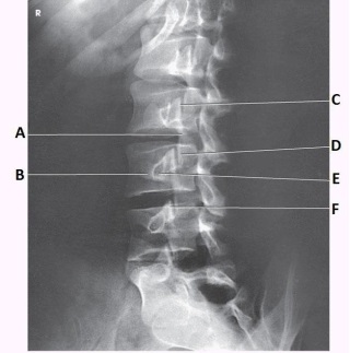If this is an AP oblique projection, what is the patient position in the image below?   A)  45 degree RPO B)  45 degree LPO C)  45 degree RAO D)  45 degree LAO