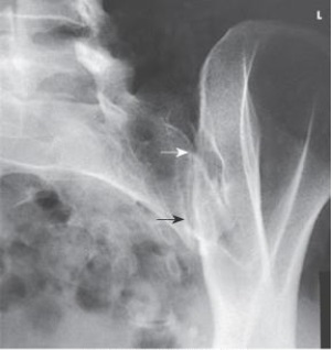 What anatomy is demonstrated in this AP oblique projection in the image below?   A)  Right SI joint B)  Left SI joint C)  L5-S1 joint space D)  L5-S1 zygapophyseal joint