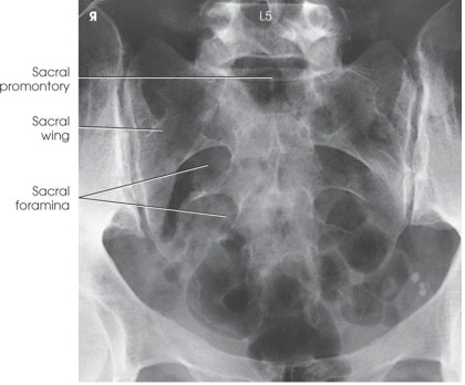 What anatomy and projection is demonstrated in the image below?   A)  AP axial sacrum B)  AP oblique SI joints C)  AP coccyx D)  AP axial lumbosacral junction (Ferguson method) 
