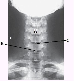 How is the central ray directed to obtain this image?   A)  15 to 20 degrees cephalad B)  15 to 20 degrees caudad C)  25 to 30 degrees cephalad D)  25 to 30 degrees caudad