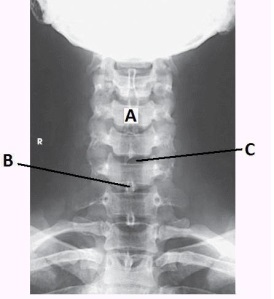 Letter B in the image below labels the:   A)  pedicle. B)  lamina. C)  spinous process. D)  transverse process.