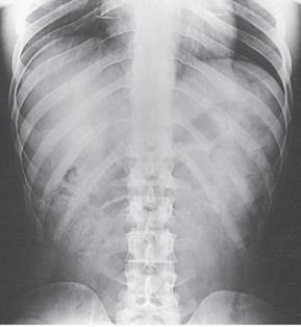 Which ribs are best demonstrated in this image?   A)  Axillary portion of the right ribs B)  Axillary portion of the left ribs C)  Ribs above the diaphragm (upper ribs)  D)  Ribs below the diaphragm (lower ribs) 