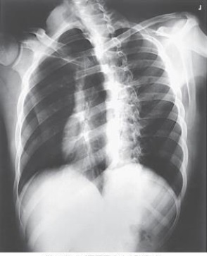 Which ribs are best demonstrated in the image below?   A)  Axillary portion of right ribs B)  Axillary portion of left ribs C)  Left ribs above the diaphragm D)  Right ribs below the diaphragm