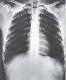 Which ribs are best demonstrated in the image below?   A)  Axillary portion of right ribs B)  Axillary portion of left ribs C)  Ribs above the diaphragm D)  Ribs below the diaphragm