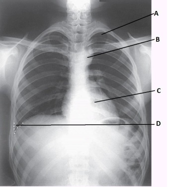 What anatomy is labeled as letter A in the image below?   A)  Apex of right lung B)  Apex of left lung C)  Costophrenic angle of right lung D)  Costophrenic angle of left lung