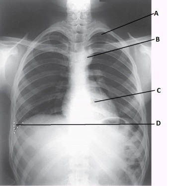What anatomy is labeled as letter D and outlined with white dots in the image below?   A)  Apex of right lung B)  Apex of left lung C)  Costophrenic angle of right lung D)  Costophrenic angle of left lung