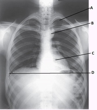 What anatomy is labeled as letter B in the image below?   A)  Apex of right lung B)  Apex of left lung C)  Aortic arch D)  Thymus gland
