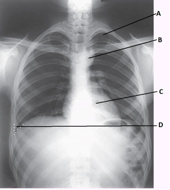 What anatomy is labeled as letter C in the image below?   A)  Thymus gland B)  Heart C)  Lingula D)  Aortic arch