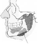 Which gland is identified in the figure below?   A)  Parotid B)  Submandibular C)  Sublingual D)  Thymus